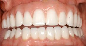 Full-Mouth-Rehab-Denture Cosmetic dentist Los Angeles CA
