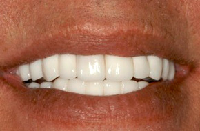 Full-Mouth-Rehab-Temp Full-Mouth-Rehab-Temp