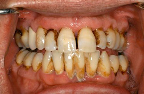 Full-Mouth-Rehabilitation Cosmetic dentist in Los Angeles CA
