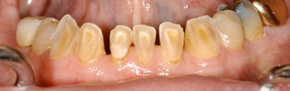 Fully-Collapsed-Bite-Erosio