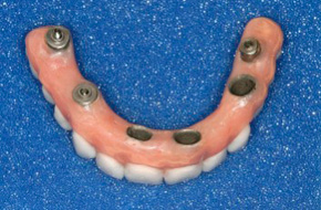 Implant-Overdenture Implant-Overdenture