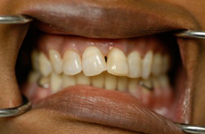 Misaligned-Anterior-Teeth