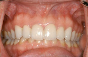 Natural-Custom-Veneers-2