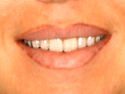 Natural-Custom-Veneers