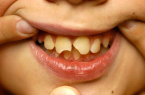 Pediatric-Trauma-Before Cosmetic dentist los angeles