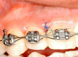 Reimplant-Evulsed-Tooth Reimplant-Evulsed-Tooth