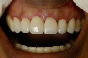 Smile-Fixed-With-6-Veneers