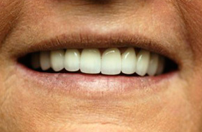 Smile-Lift-After-A Smile-Lift-After-A