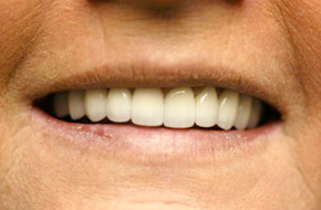 Smile-Lift-After-B Smile-Lift-After-B
