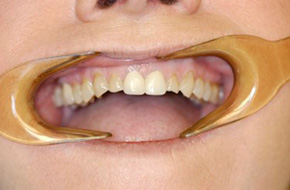 Smile-Lift-Before-A Smile-Lift-Before-A