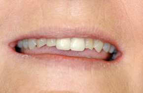 Smile-Lift-Before-B Smile-Lift-Before-B