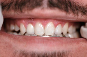 Tooth-Replaced-Implant Tooth-Replaced-Implant