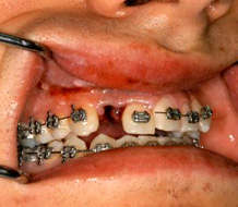 Trauma-During-Orthodontia Trauma-During-Orthodontia