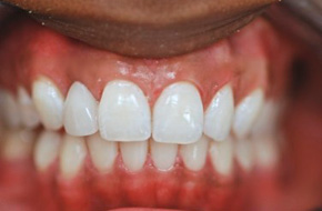 single-implant-crown Cosmetic dentist los angeles
