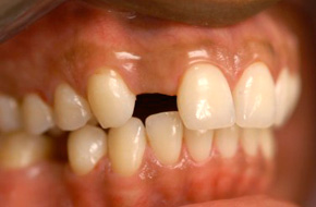 single-missing-tooth single-missing-tooth