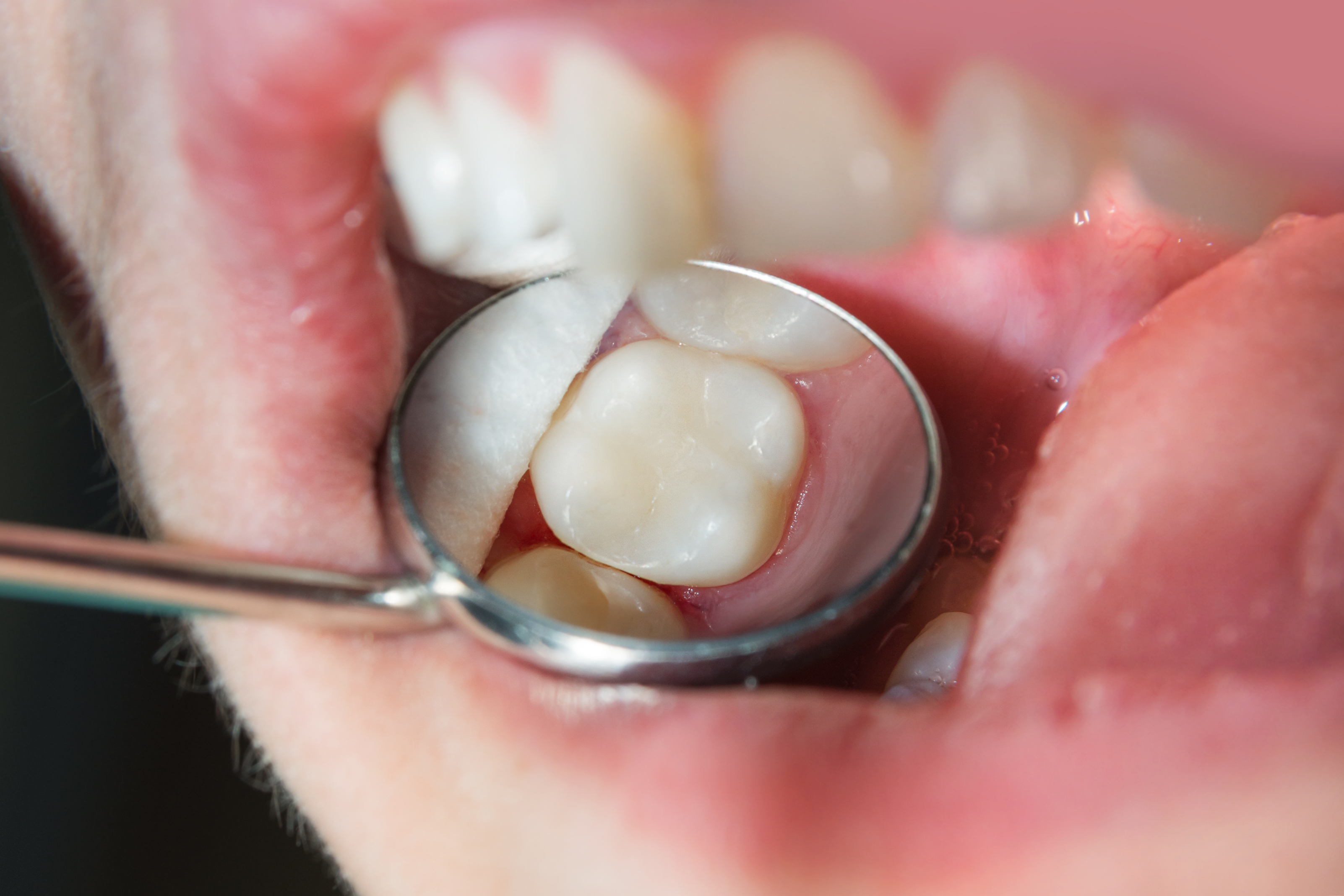 Dental Fillings NYC  Cavity Treatment Dentist - Sohosmile