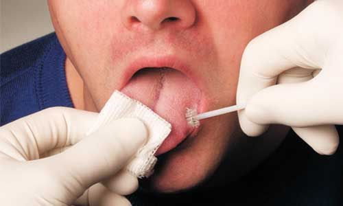 Oral Cancer Testing Los Angeles