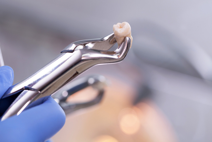 tooth extraction los angeles