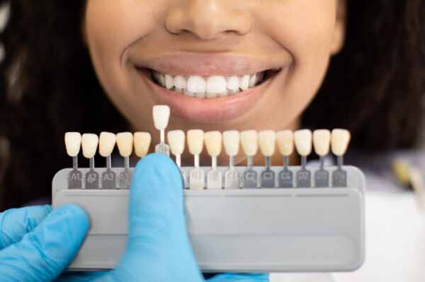 what are dental veneers