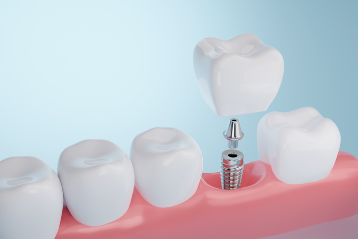 Dental implant